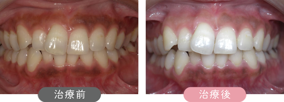 治療前後